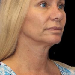 Revision Rhinoplasty Before & After Patient #1178