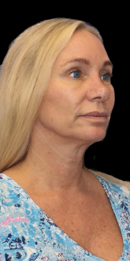 Revision Rhinoplasty Before & After Patient #1178
