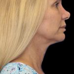 Revision Rhinoplasty Before & After Patient #1178