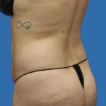 Brazilian Butt Lift Before & After Patient #1179