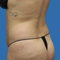 Brazilian Butt Lift Before & After Patient #1179