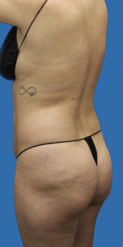 Brazilian Butt Lift Before & After Patient #1179