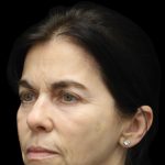 Facelift Before & After Patient #1180
