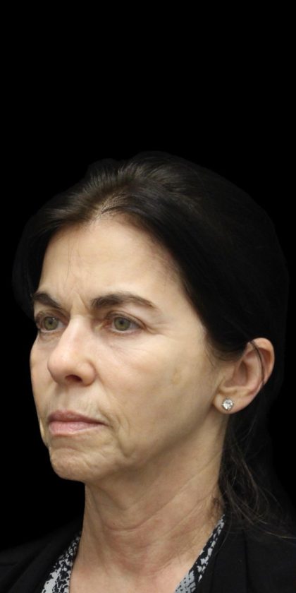 Facelift Before & After Patient #1180