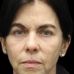 Facelift Before & After Patient #1180
