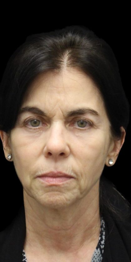 Facelift Before & After Patient #1180