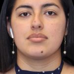 Primary Rhinoplasty Before & After Patient #1181