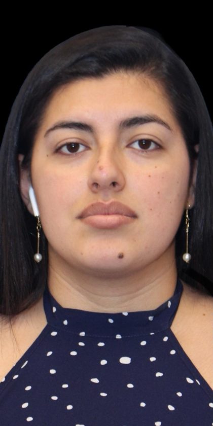 Primary Rhinoplasty Before & After Patient #1181