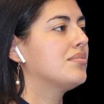 Primary Rhinoplasty Before & After Patient #1181