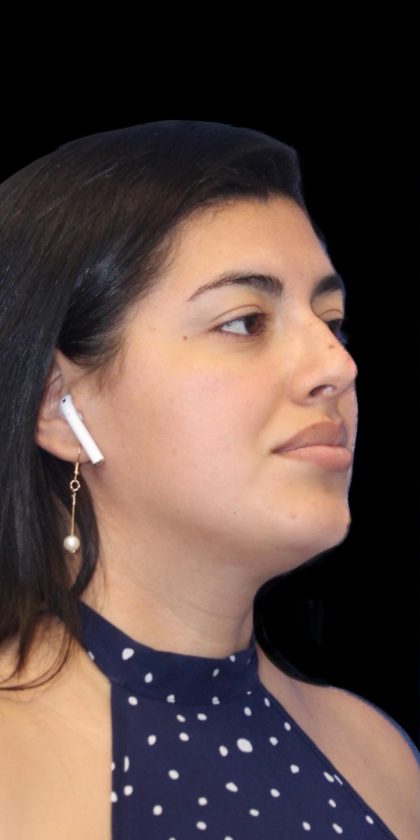 Primary Rhinoplasty Before & After Patient #1181