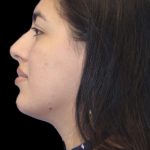 Primary Rhinoplasty Before & After Patient #1181
