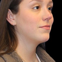 Primary Rhinoplasty Before & After Patient #1182