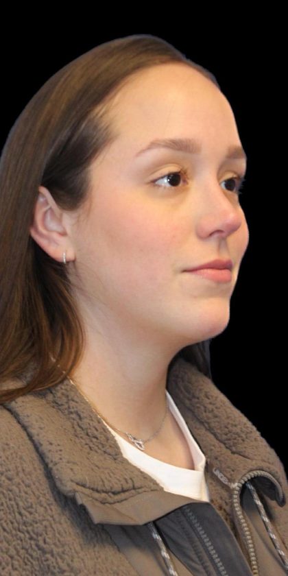 Primary Rhinoplasty Before & After Patient #1182