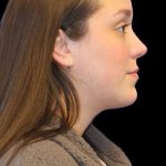 Primary Rhinoplasty Before & After Patient #1182