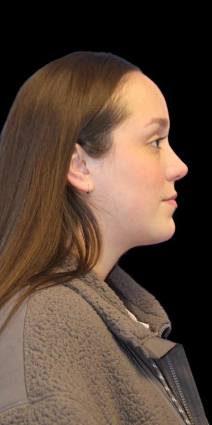 Primary Rhinoplasty Before & After Patient #1182