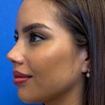 Primary Rhinoplasty Before & After Patient #1186