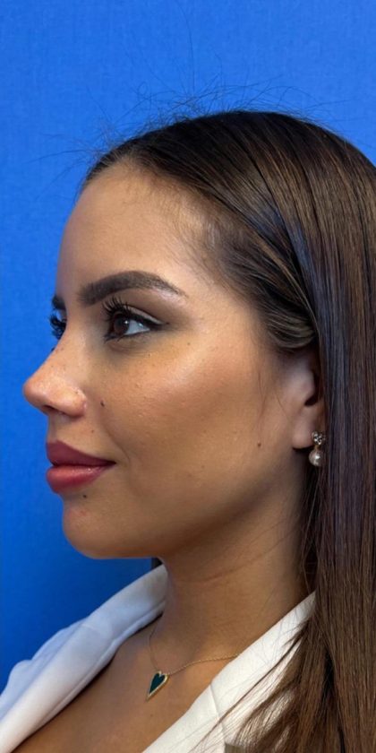 Primary Rhinoplasty Before & After Patient #1186