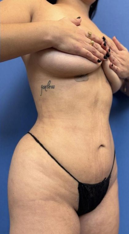 Brazilian Butt Lift Before & After Patient #1174