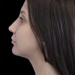 Primary Rhinoplasty Before & After Patient #1175