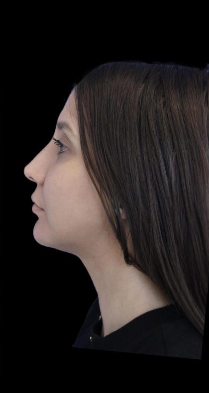 Primary Rhinoplasty Before & After Patient #1175