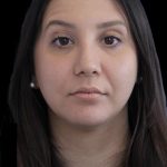 Primary Rhinoplasty Before & After Patient #1175