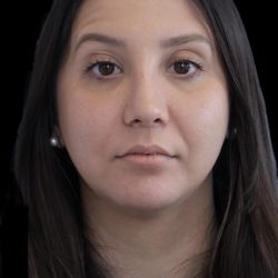 Primary Rhinoplasty Before & After Patient #1175