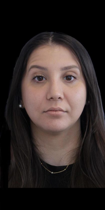 Primary Rhinoplasty Before & After Patient #1175