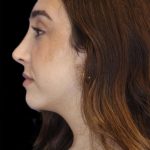 Primary Rhinoplasty Before & After Patient #1176