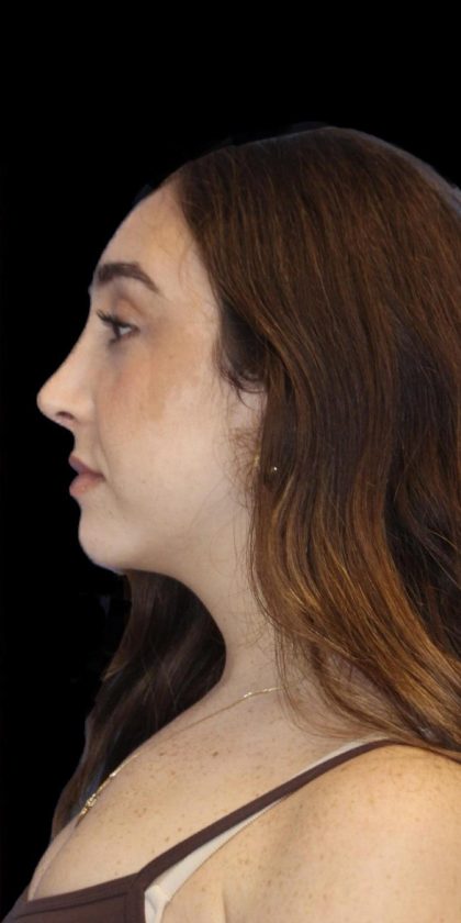 Primary Rhinoplasty Before & After Patient #1176