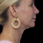 Revision Rhinoplasty Before & After Patient #1178