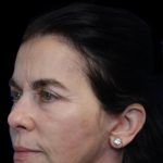 Facelift Before & After Patient #1180