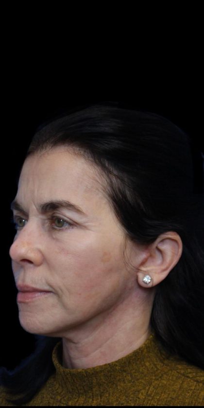 Facelift Before & After Patient #1180