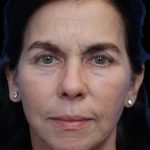 Facelift Before & After Patient #1180