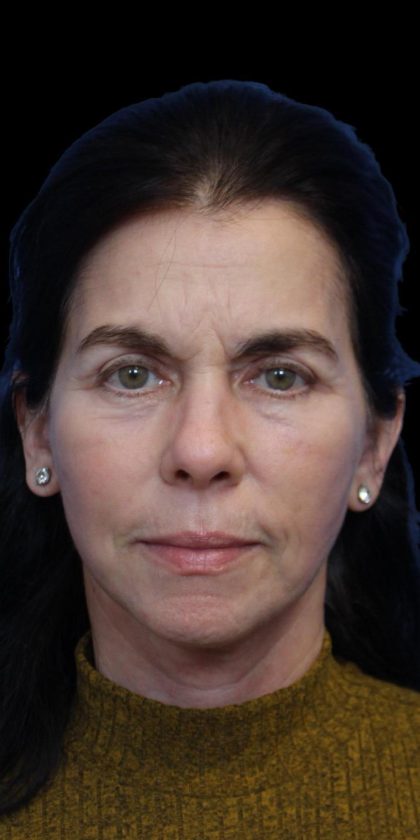 Facelift Before & After Patient #1180