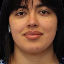 Primary Rhinoplasty Before & After Patient #1181