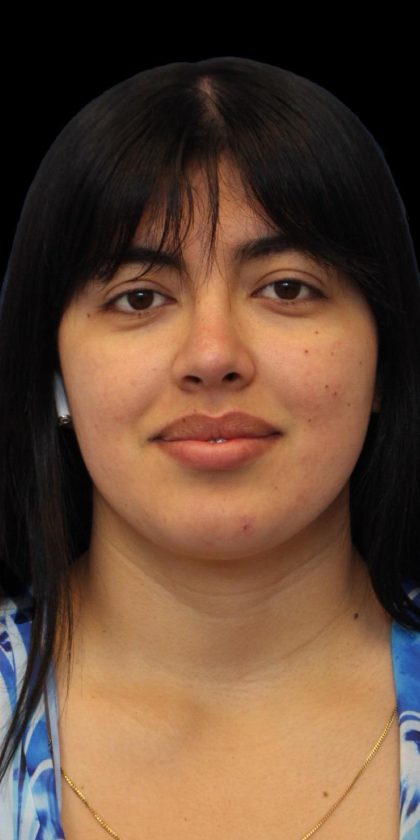 Primary Rhinoplasty Before & After Patient #1181
