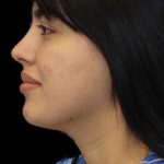 Primary Rhinoplasty Before & After Patient #1181