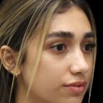 Primary Rhinoplasty Before & After Patient #1322