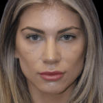 Primary Rhinoplasty Before & After Patient #1306