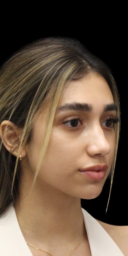 Primary Rhinoplasty Before & After Patient #1322
