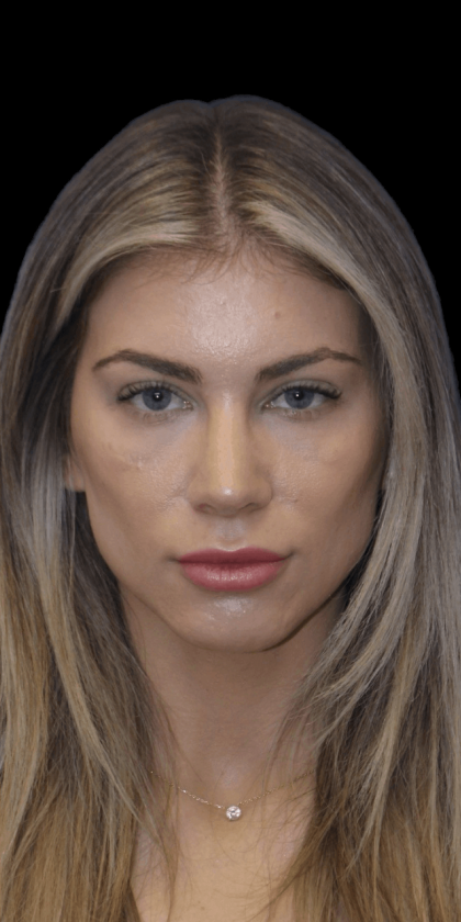 Primary Rhinoplasty Before & After Patient #1306