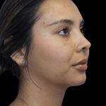 Primary Rhinoplasty Before & After Patient #1321