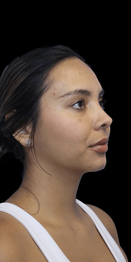 Primary Rhinoplasty Before & After Patient #1321