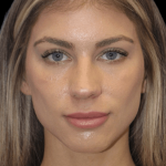 Primary Rhinoplasty Before & After Patient #1306