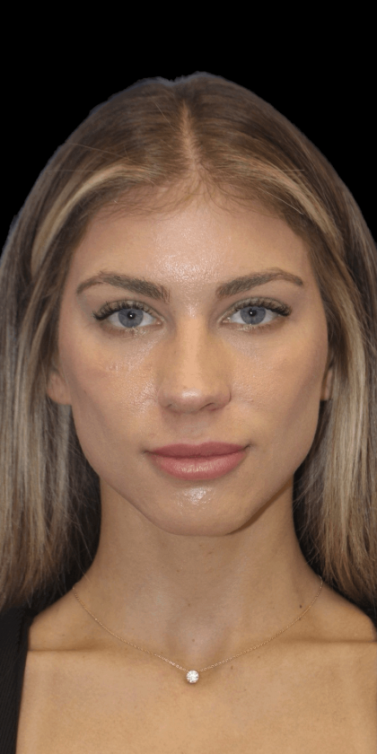 Primary Rhinoplasty Before & After Patient #1306