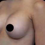 Breast Augmentation Before & After Patient #1328