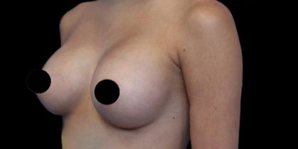 Breast Augmentation Before & After Patient #1328