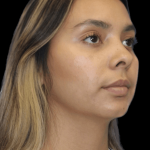 Primary Rhinoplasty Before & After Patient #1321