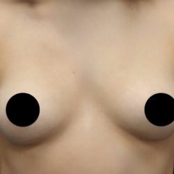Breast Augmentation Before & After Patient #1328