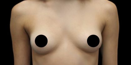 Breast Augmentation Before & After Patient #1328